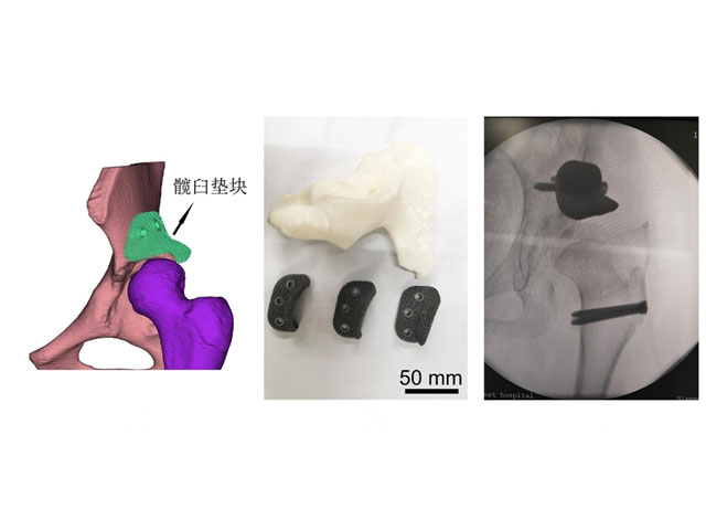鉭墊塊輔助髖外科脫位入路下髖臼造蓋術（與西南醫院合作）